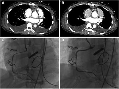 Case report: Acute right ventricular dysfunction after surgery in a pregnant patient with congenital heart disease and aortic dissection
